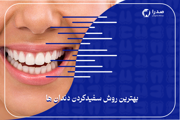 بهترین روش سفید کردن دندان بهترین روش سفید کردن دندان