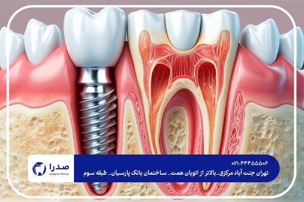 بهترین دندانپزشک ایمپلنت در غرب تهران
