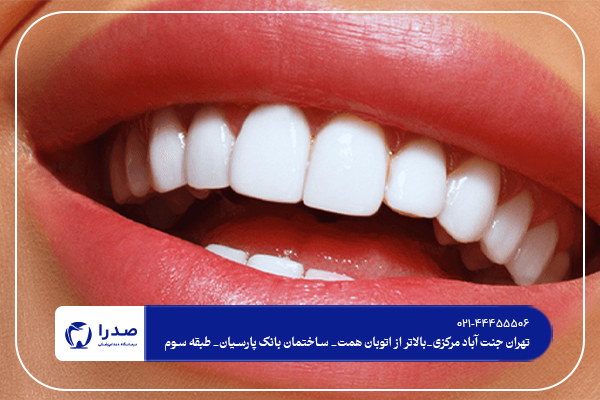 فرق بین لمینت و کامپوزیت دندان فرق بین لمینت و کامپوزیت دندان