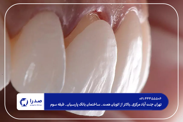 فرق بین لمینت و کامپوزیت دندان فرق بین لمینت و کامپوزیت دندان