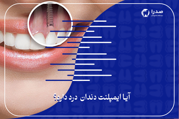 آیا ایمپلنت دندان درد دارد؟ آیا ایمپلنت دندان درد دارد؟
