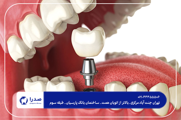 آیا ایمپلنت دندان درد دارد؟ آیا ایمپلنت دندان درد دارد؟