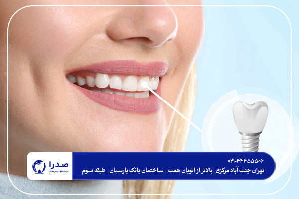 آیا ایمپلنت دندان درد دارد؟ آیا ایمپلنت دندان درد دارد؟