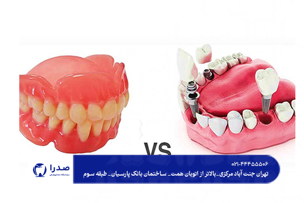 ایمپلنت به صرفه تر است یا دندان مصنوعی؟
