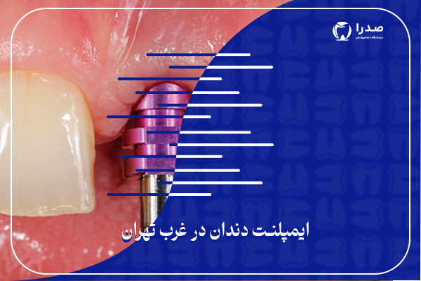 ایمپلنت دندان در غرب تهران
