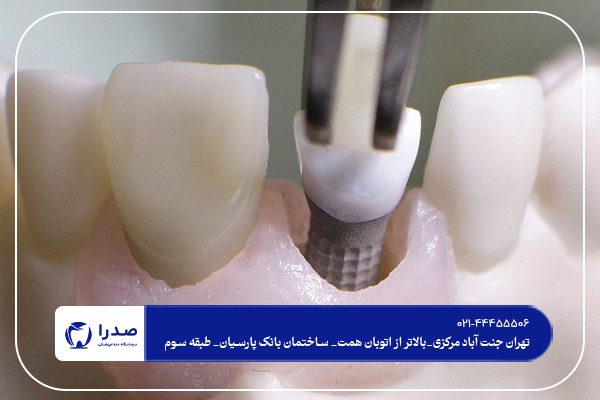 ایمپلنت دندان در غرب تهران
