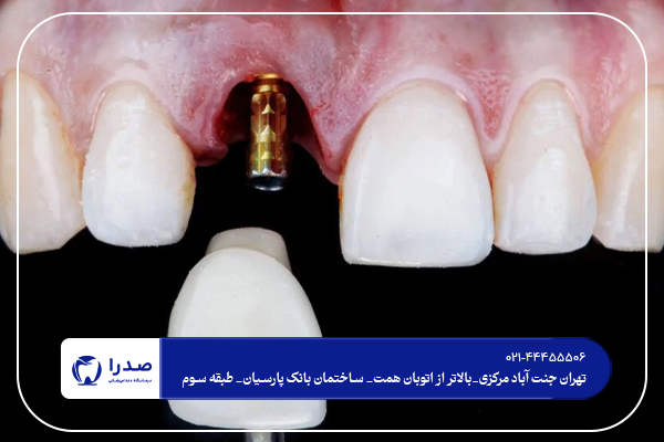 ایمپلنت دندان در غرب تهران