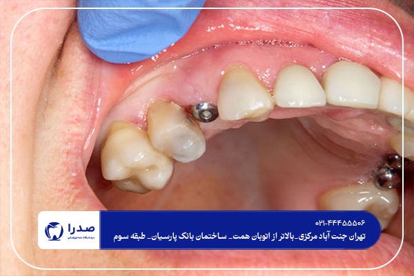 دندانپزشک ایمپلنت در مرزداران