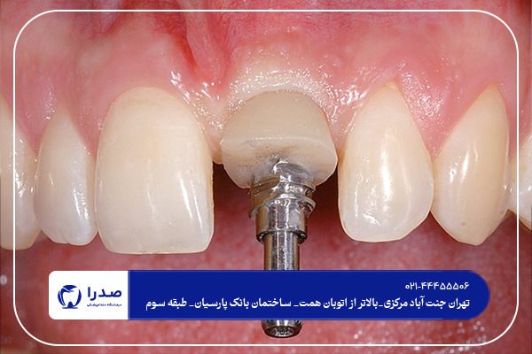دندانپزشک ایمپلنت