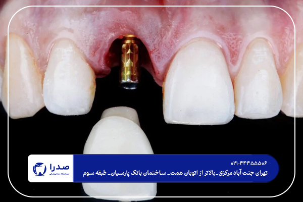 هزینه ایمپلنت