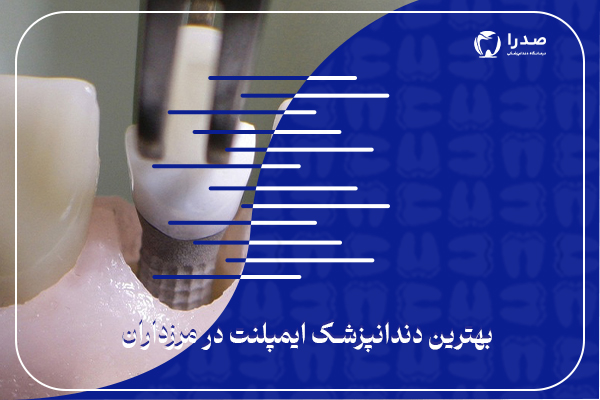 بهترین دندانپزشک ایمپلنت در مرزداران