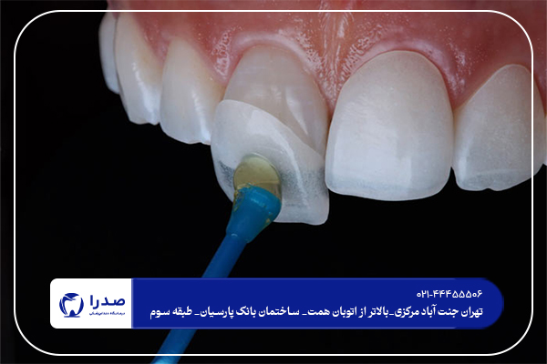 بهترین دندانپزشک کامپوزیت در تهران