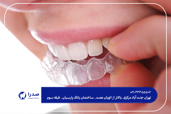 تفاوت بین بلیچینگ وجرم گیری دندان