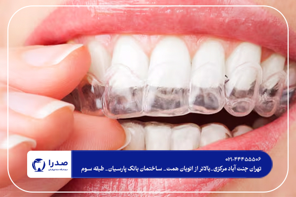 تفاوت بین بلیچینگ وجرم گیری دندان