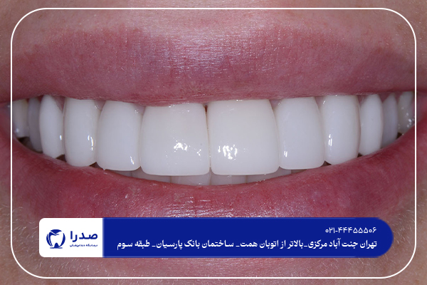 دندانپزشکی کامپوزیت در تهران دندانپزشکی کامپوزیت در تهران