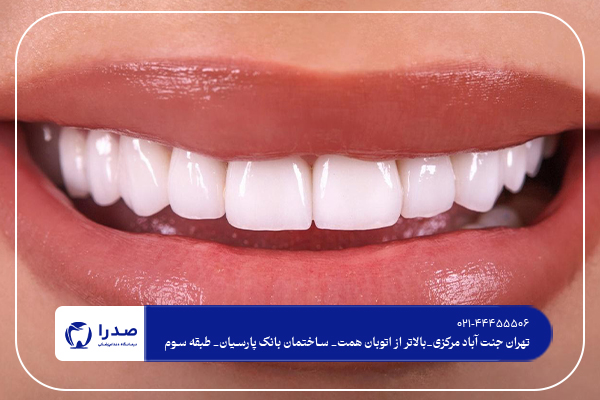 دندانپزشکی کامپوزیت در تهران دندانپزشکی کامپوزیت در تهران