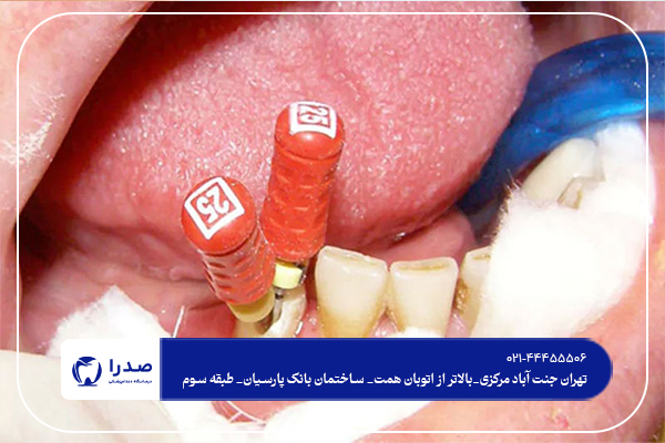 مراقبت های بعد از عصب کشی دندان