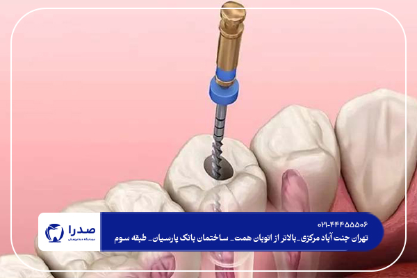 مراقبت های بعد از عصب کشی دندان