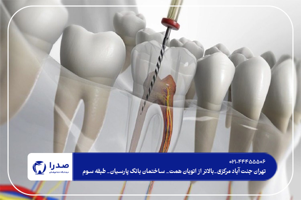 مراقبت های بعد از عصب کشی دندان