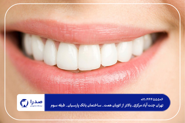 ونیر کامپوزیت