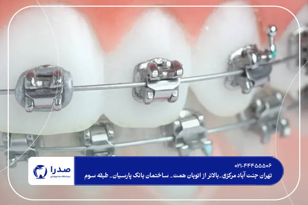 مناسب ترین سن برای ارتودنسی کودکان