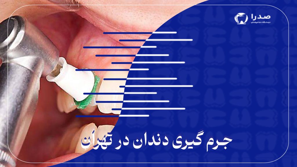 جرم گیری دندان در تهران