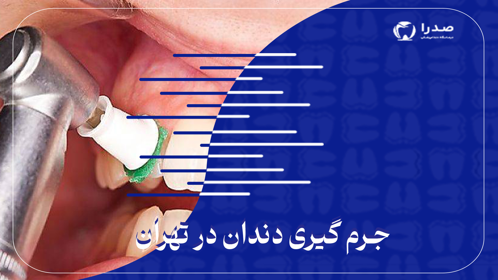 جرم گیری دندان در تهران