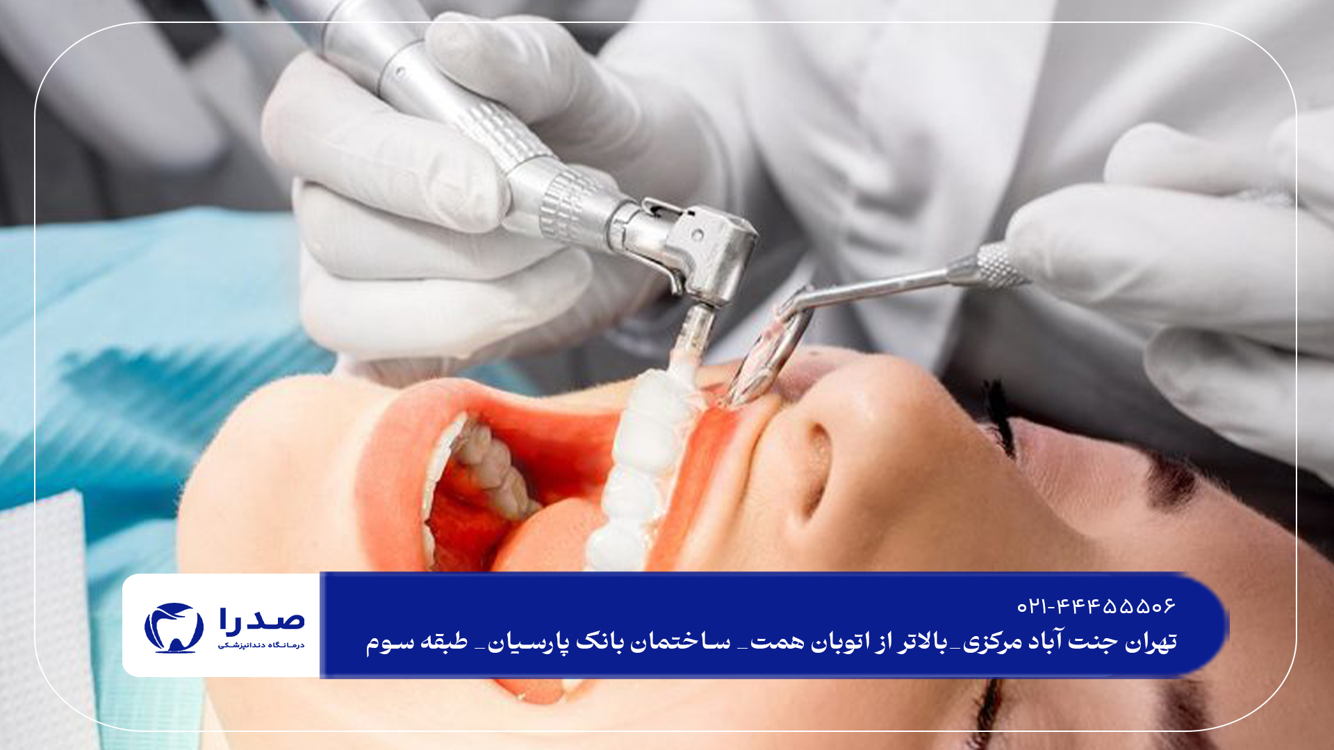 جرم گیری دندان در تهران