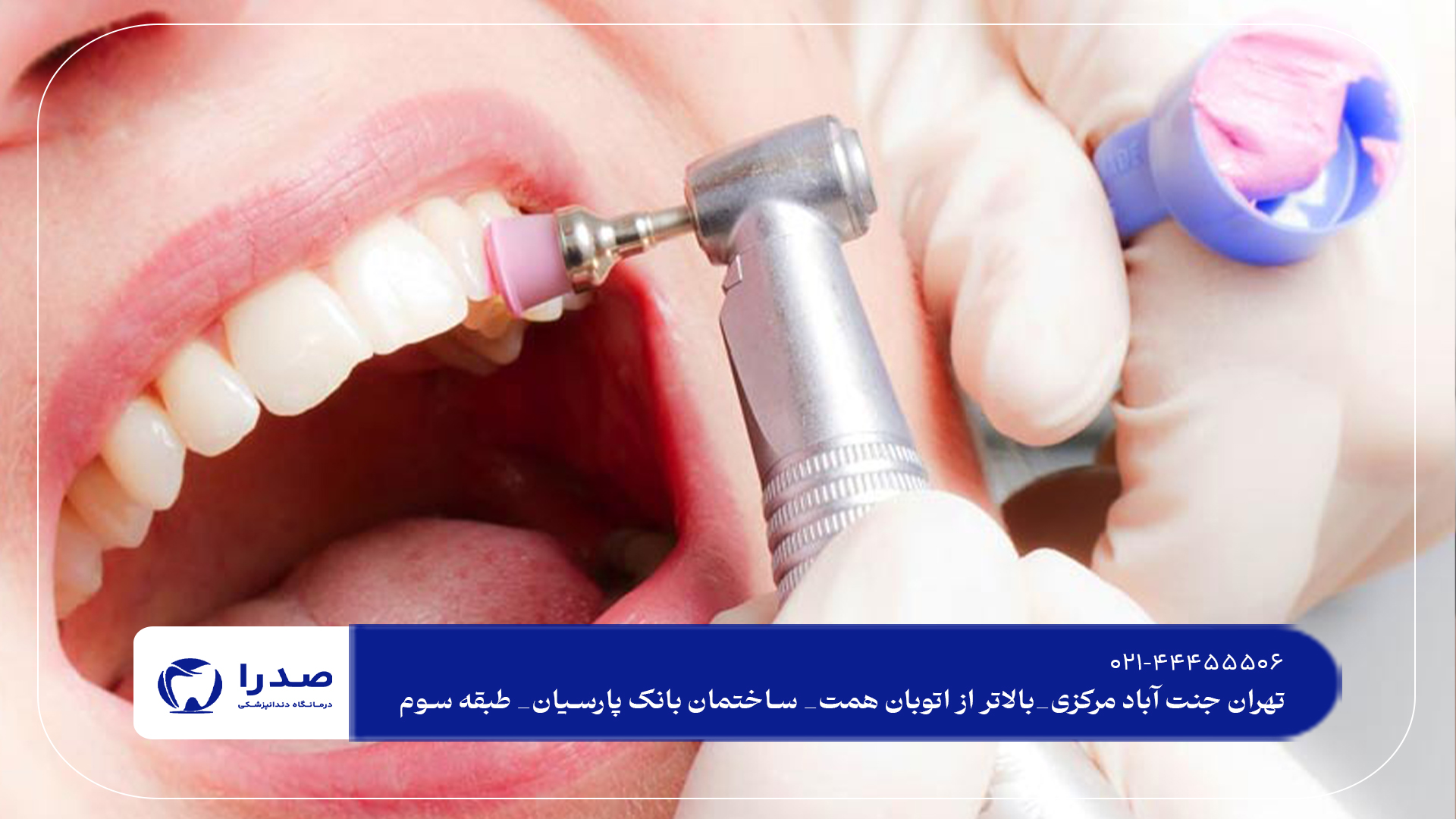 جرم گیری دندان در تهران