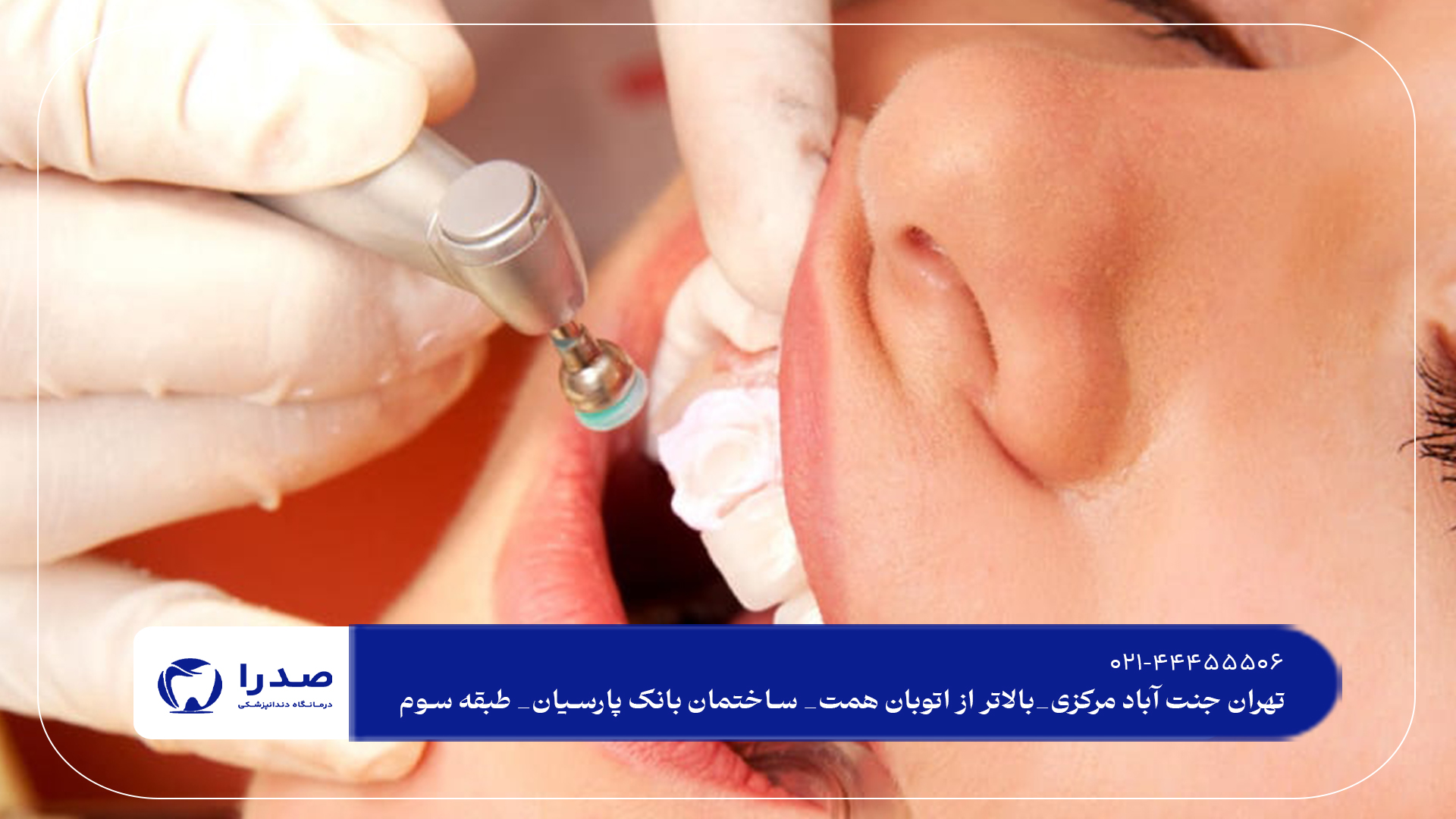 جرم گیری دندان در تهران