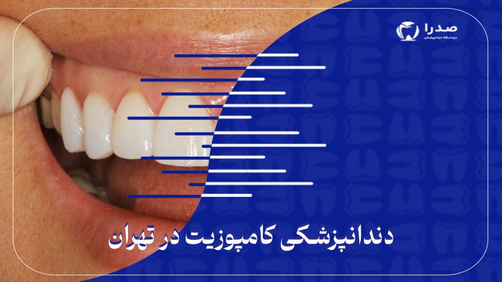 دندانپزشکی کامپوزیت در تهران