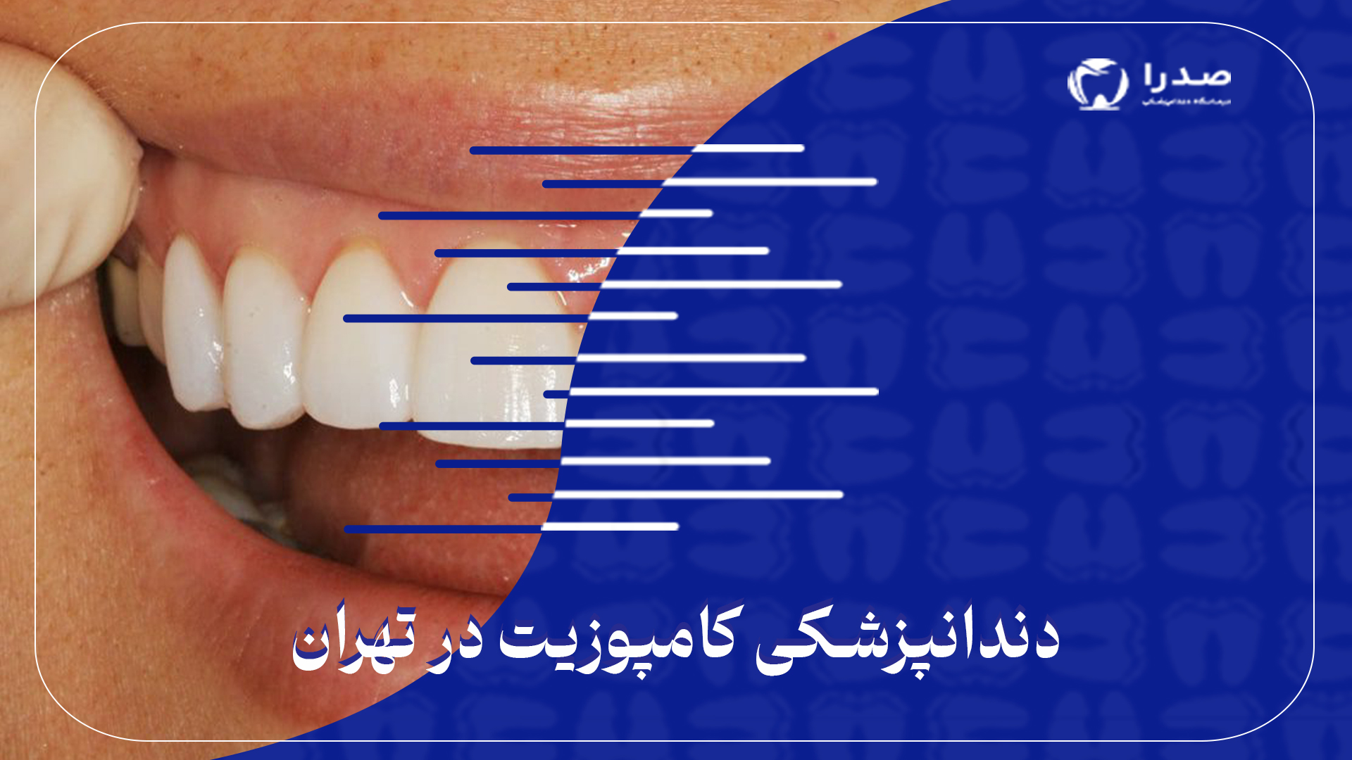 دندانپزشکی کامپوزیت در تهران