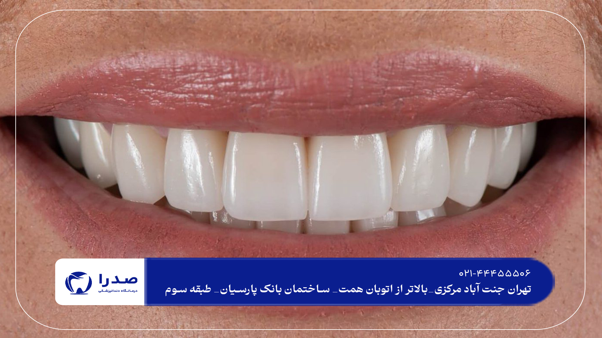 دندانپزشکی کامپوزیت در تهران