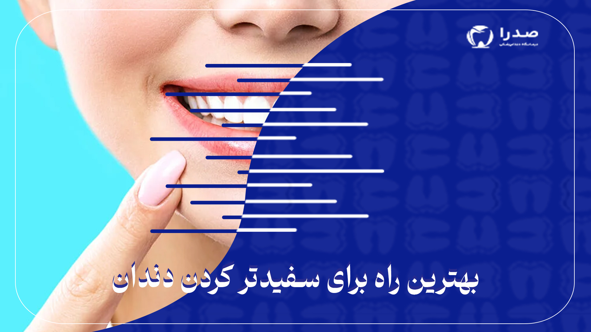 بهترین راه برای سفید تر کردن دندان