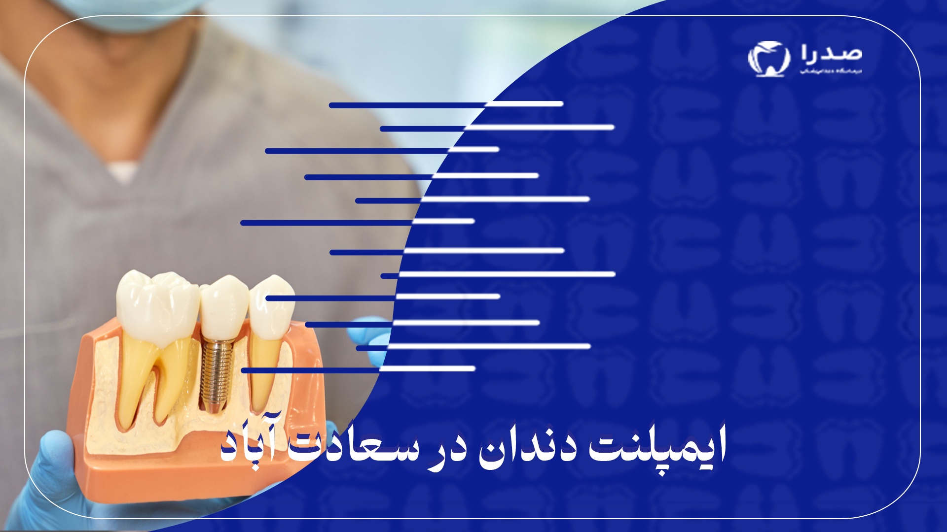 ایمپلنت دندان در سعادت آباد