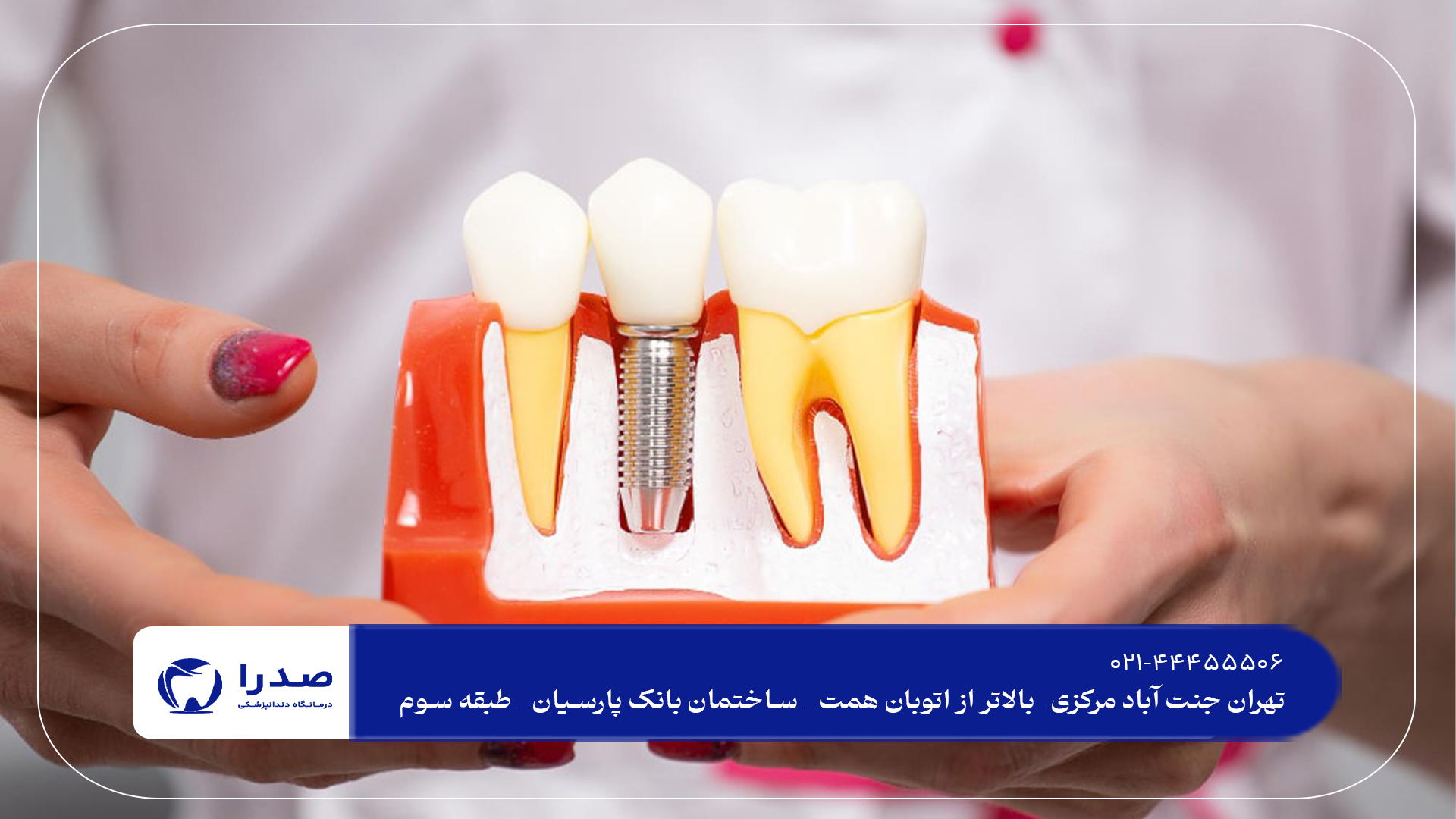 ایمپلنت دندان در سعادت آباد