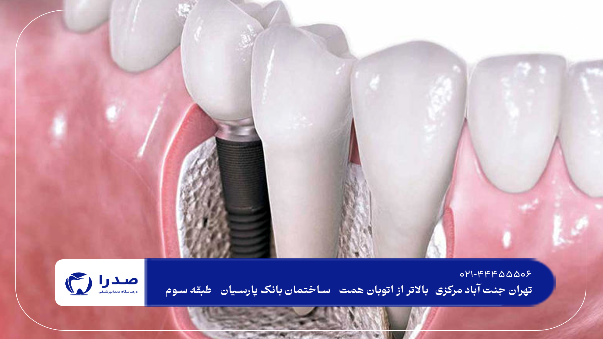 بهترین ایمپلنت دندان در تهران بهترین ایمپلنت دندان در تهران