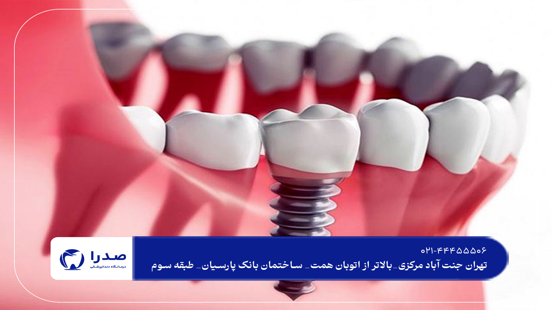 بهترین ایمپلنت دندان در تهران بهترین ایمپلنت دندان در تهران