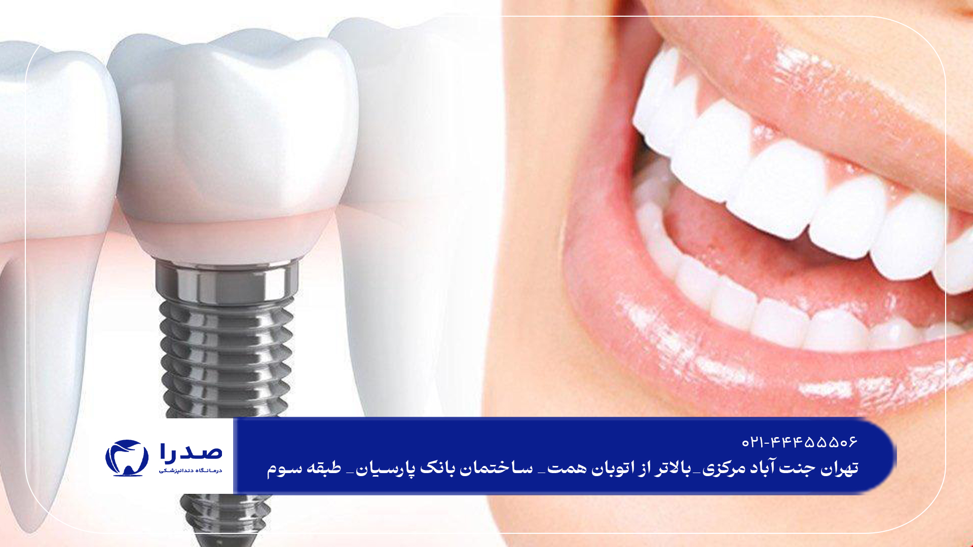 بهترین ایمپلنت دندان در تهران بهترین ایمپلنت دندان در تهران