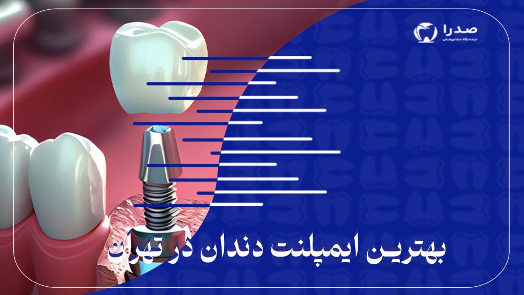 بهترین ایمپلنت دندان در تهران
