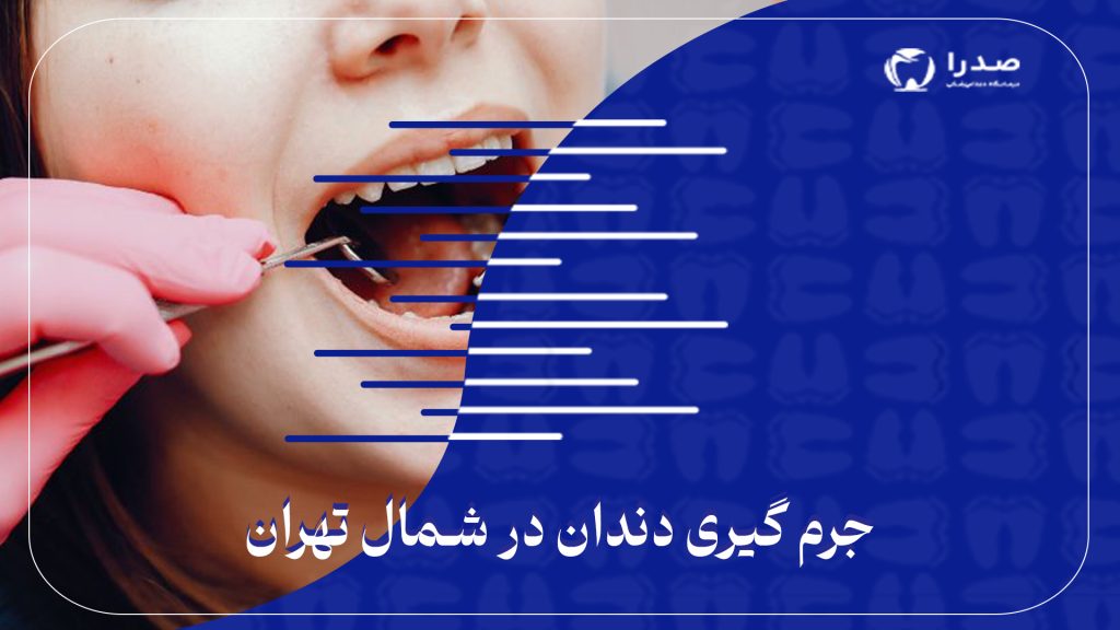 اهمیت جرم گیری دندان