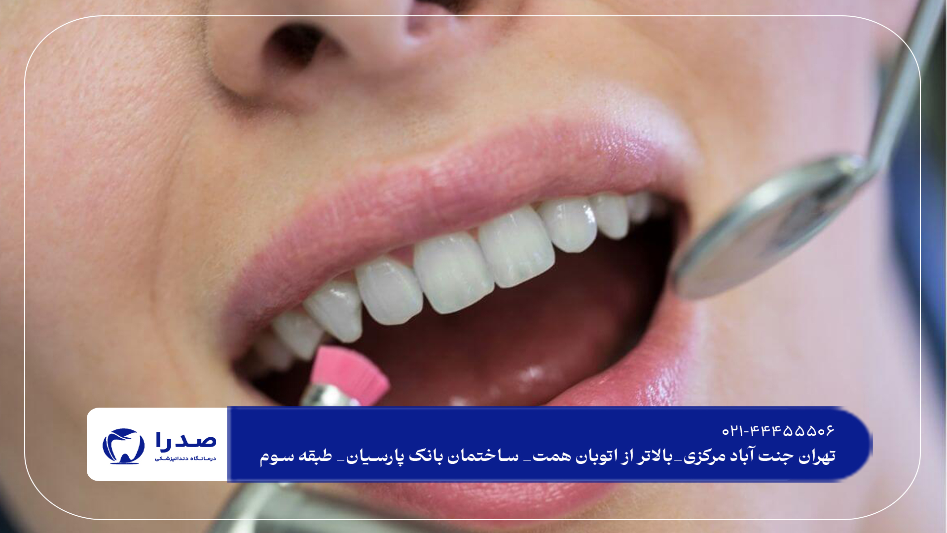 جرمگیری دندان در شمال تهران