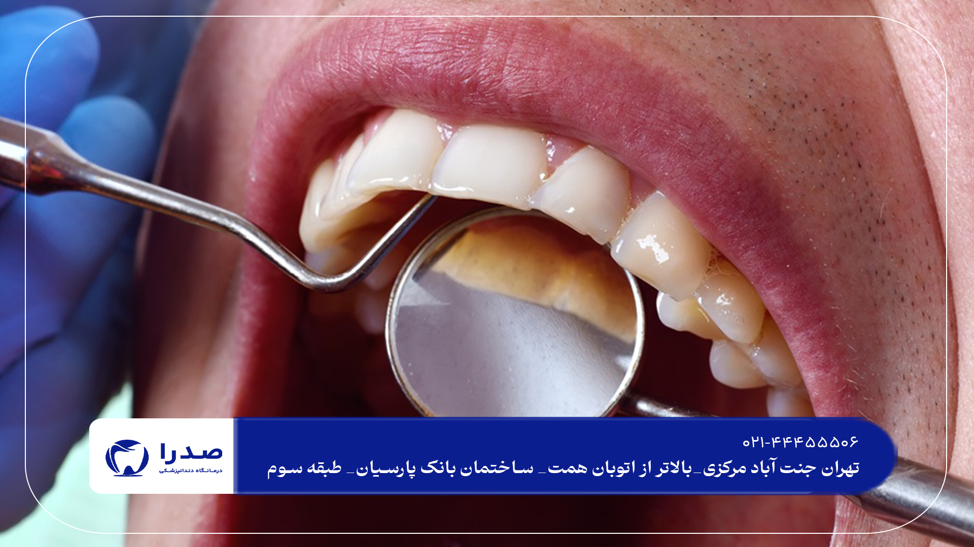 جرمگیری دندان در شمال تهران