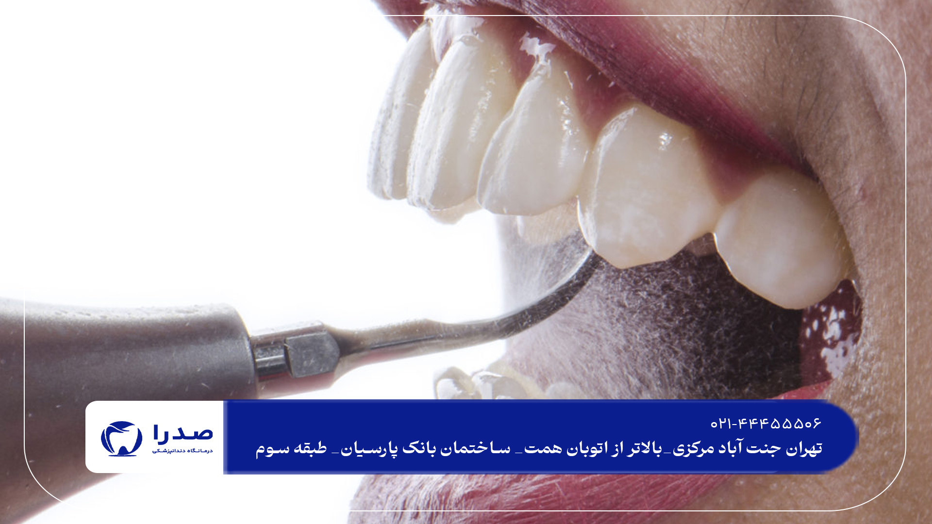 جرمگیری دندان در شمال تهران