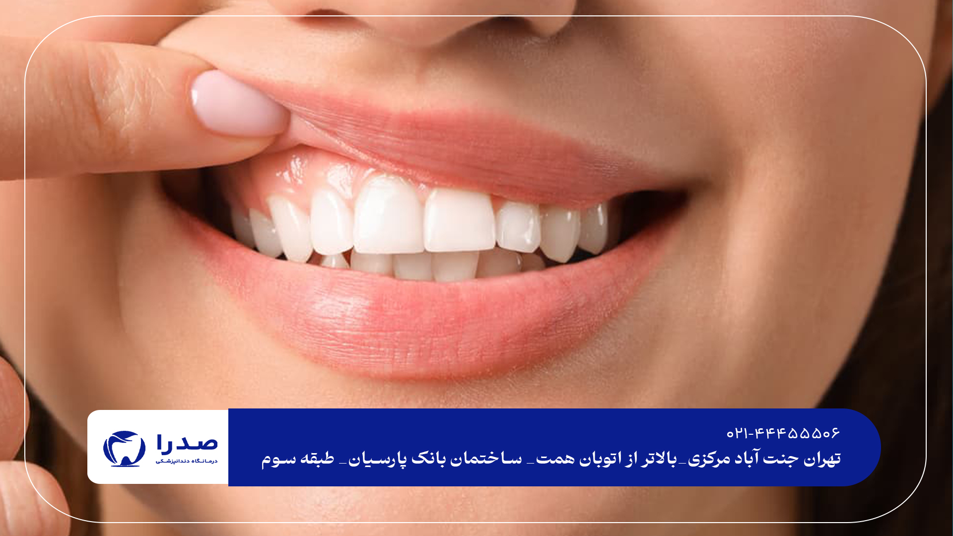 اصلاح طرح لبخند در تهران اصلاح طرح لبخند در تهران