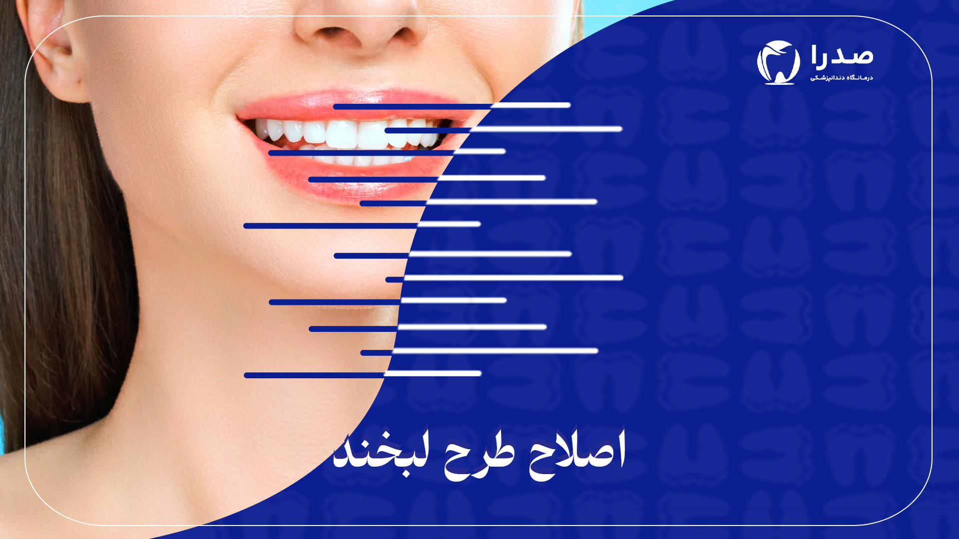 اصلاح طرح لبخند اصلاح طرح لبخند