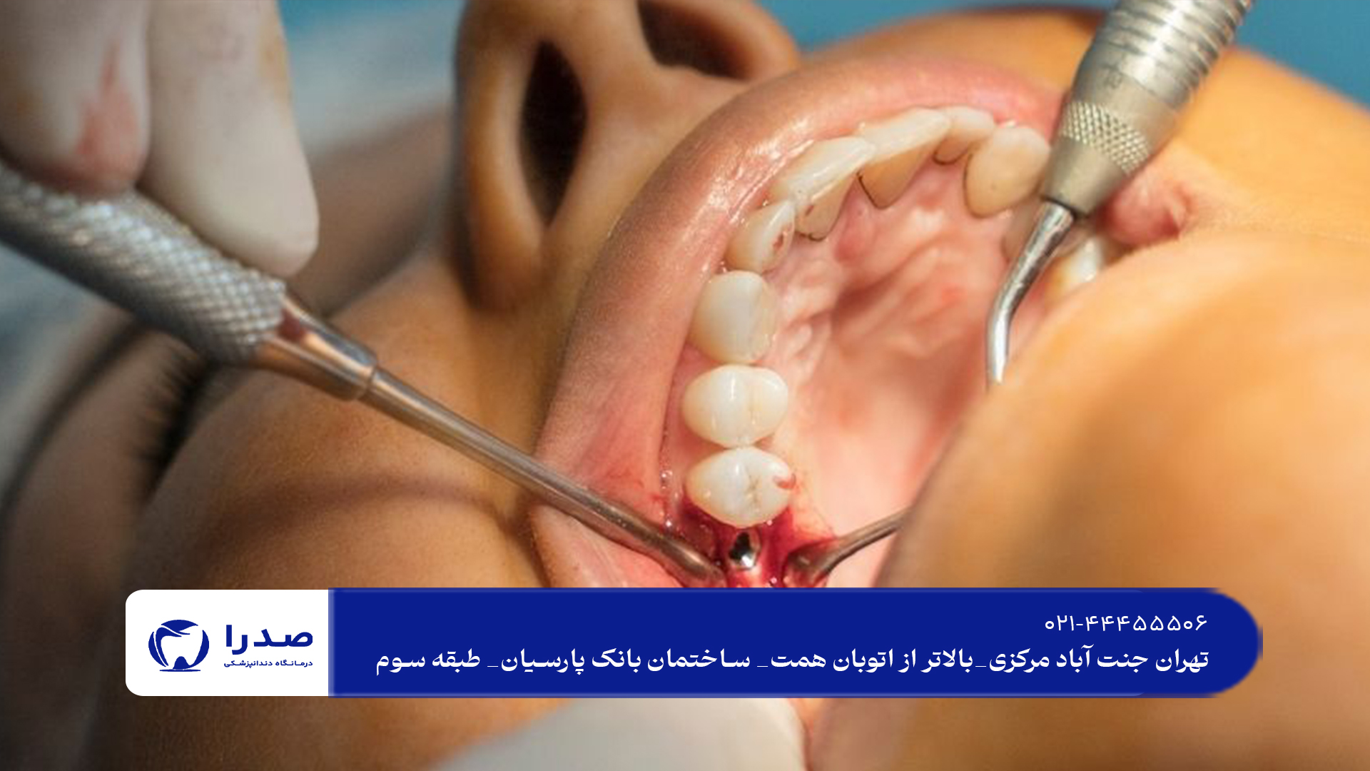 ایمپلنت دندان و مزایای آن