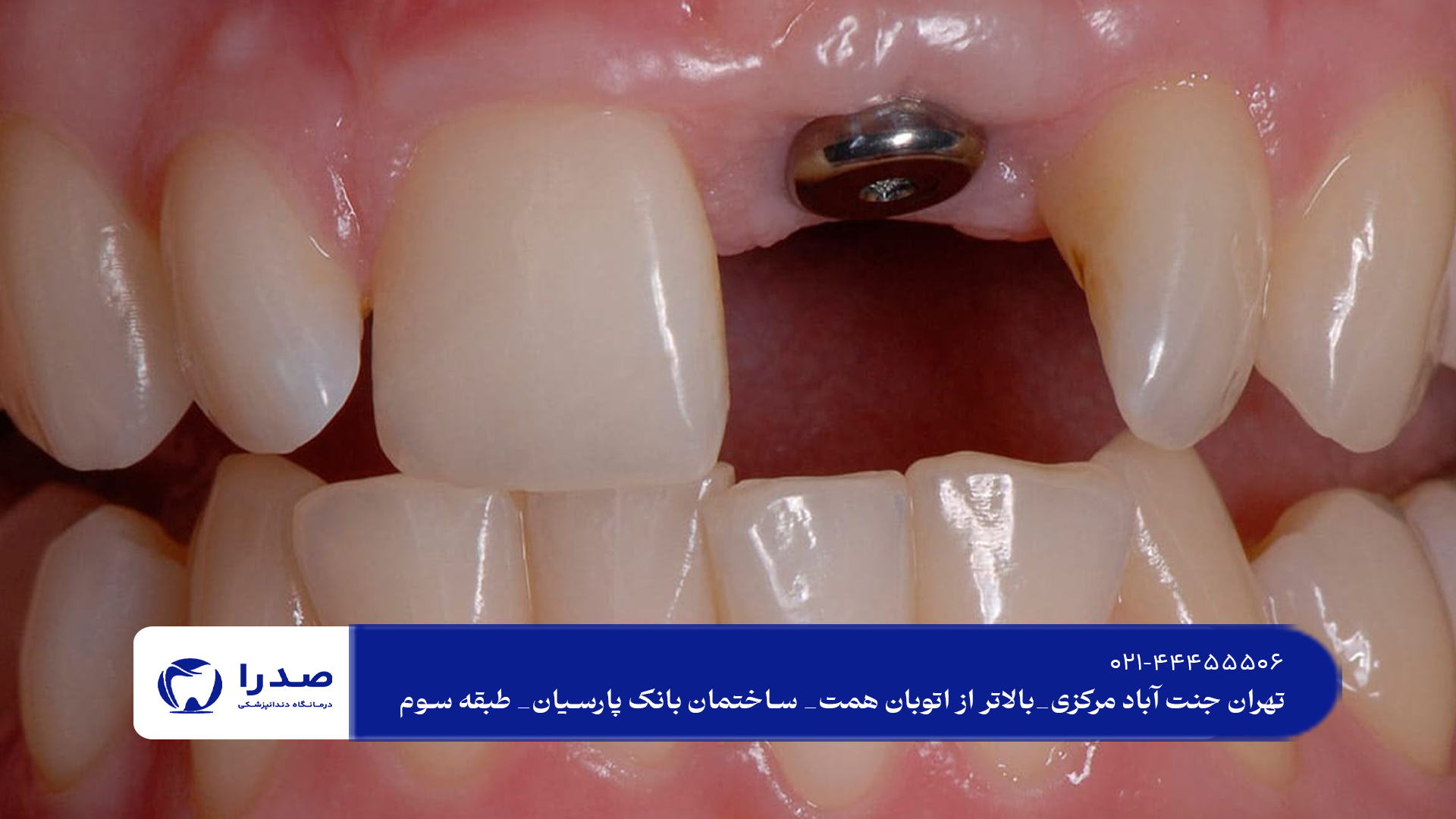 ایمپلنت دندان و مزایای آن