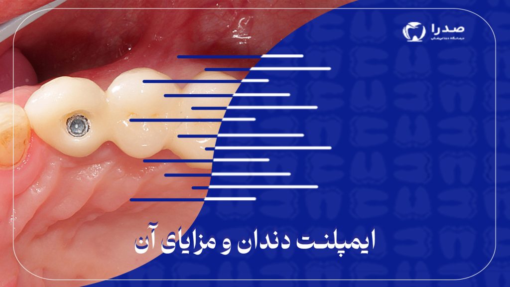 ایمپلنت دندان و مزایای آن