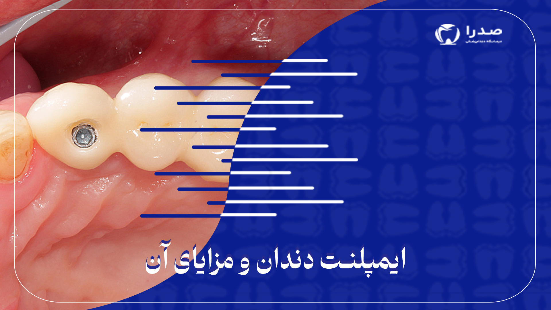 ایمپلنت دندان و مزایای آن